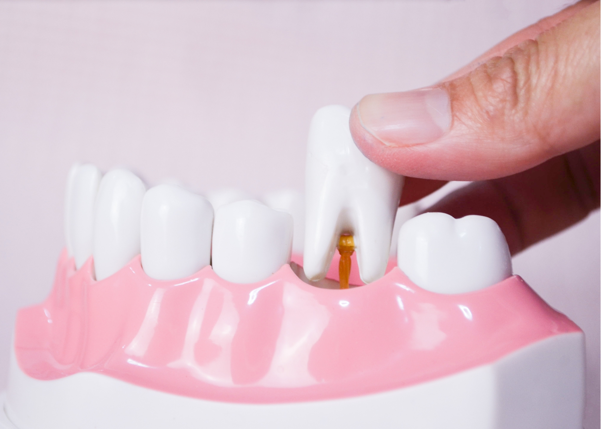 Scopri di più sull'articolo Diabete e Denti: ecco come prevenire la perdita di denti