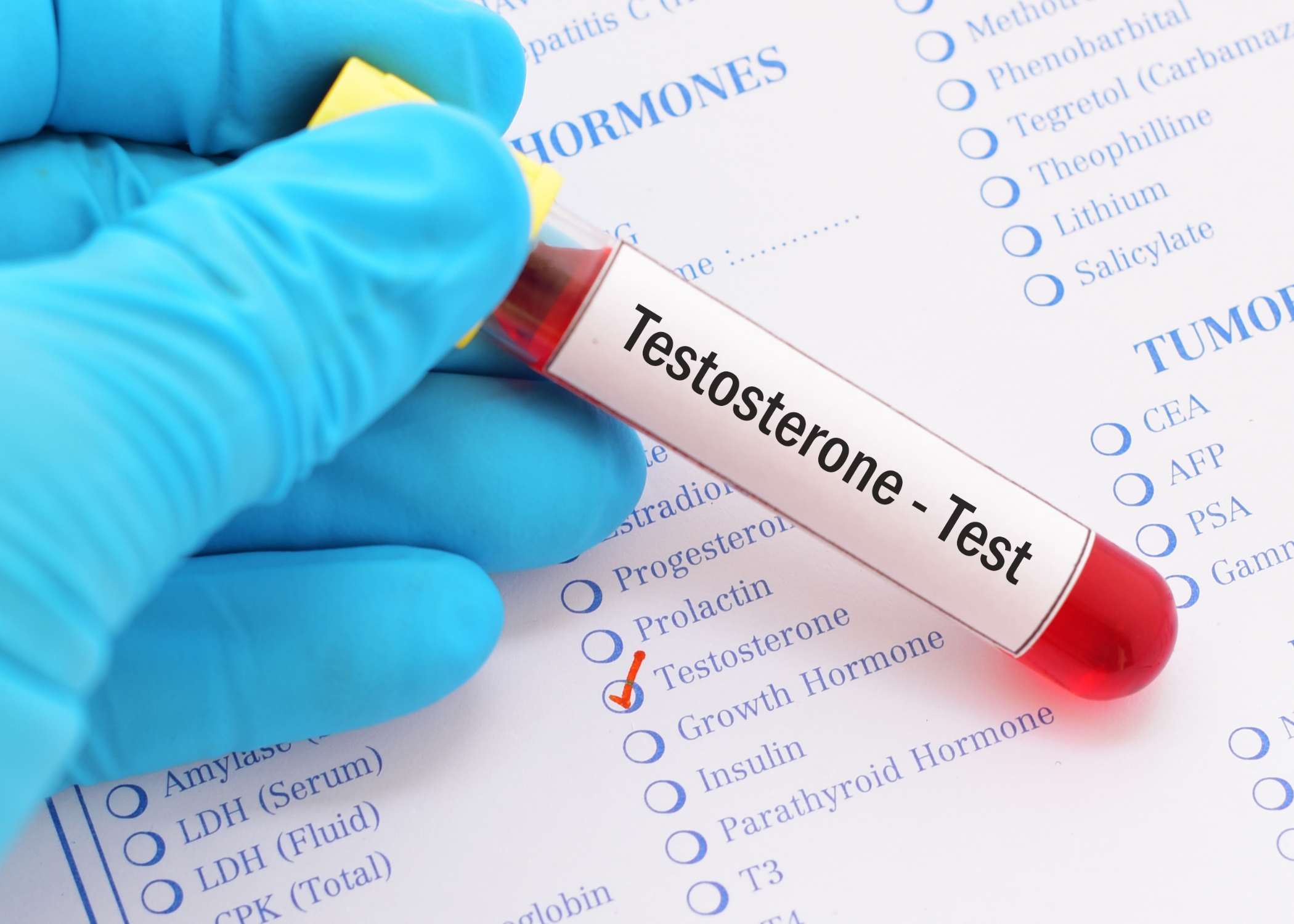 Scopri di più sull'articolo Test dei livelli di testosterone: di cosa si tratta?