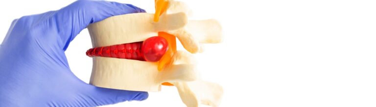Scopri di più sull'articolo Spondilolistesi a Frosinone | F-Medical