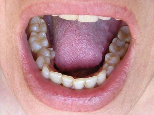 Dente del giudizio sintomi dolore estrazione
