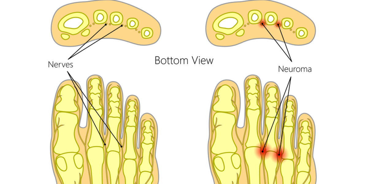 anatomia patologica neuroma planatare medical group
