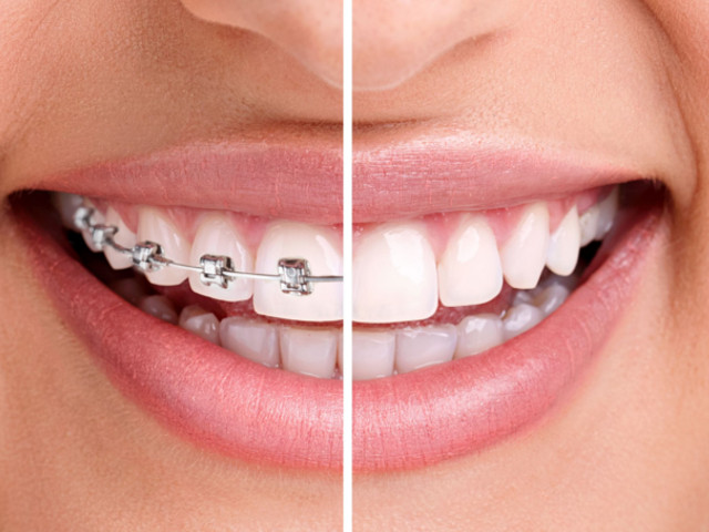 come pulire apparecchio denti