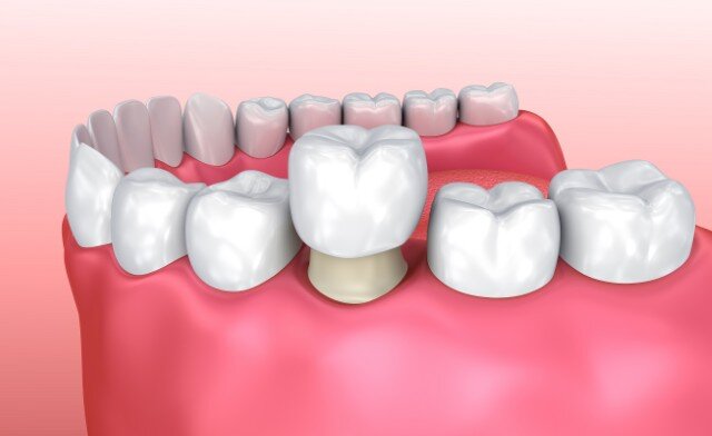 corona dentale