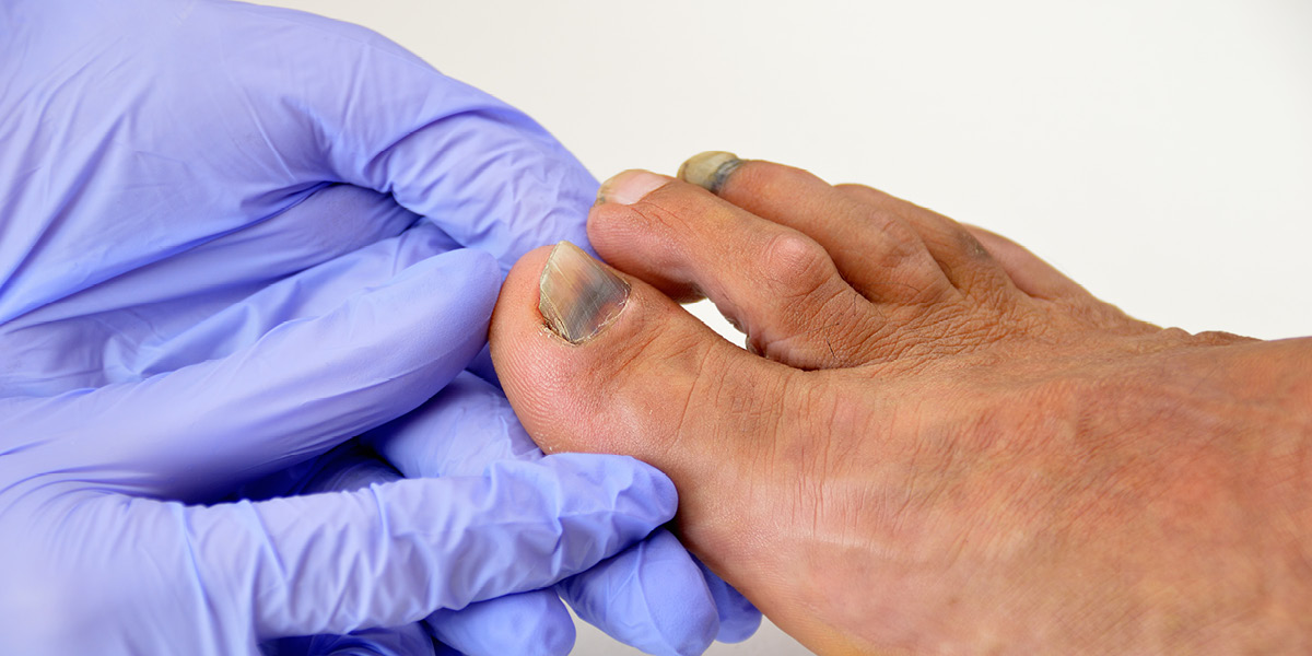 cosa sono le linee sulle unghie medical group