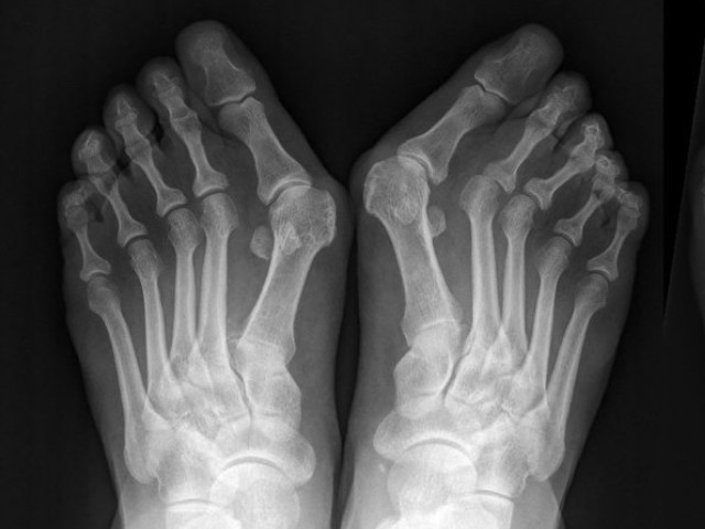 diagnosi alluce valgo