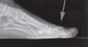 diagnosi dita a martello