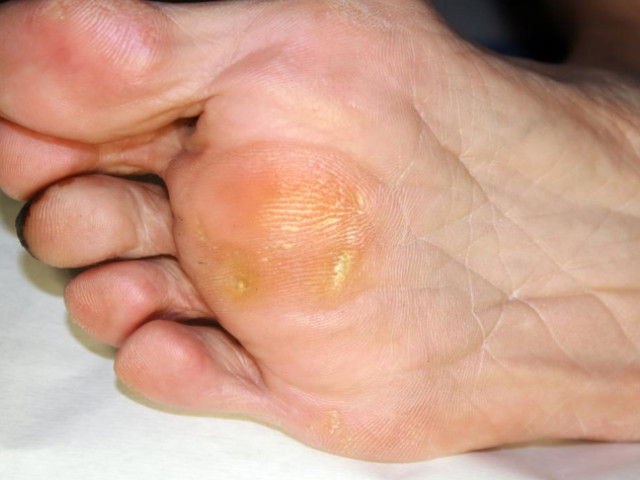 diagnosi verruche