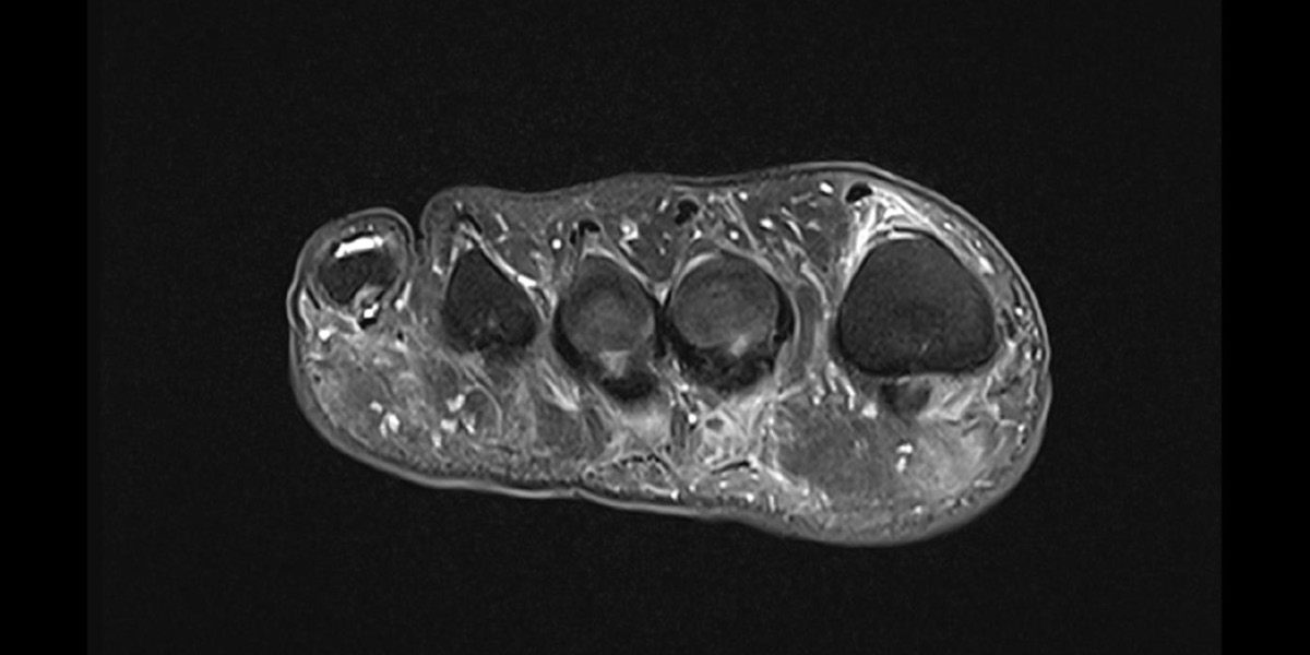 esame neuroma di morton medical group