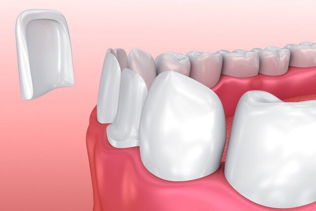 faccette dentali