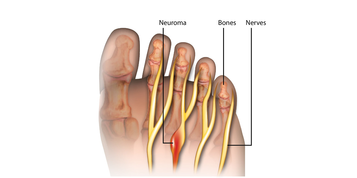 metatarsalgia di morton medical group