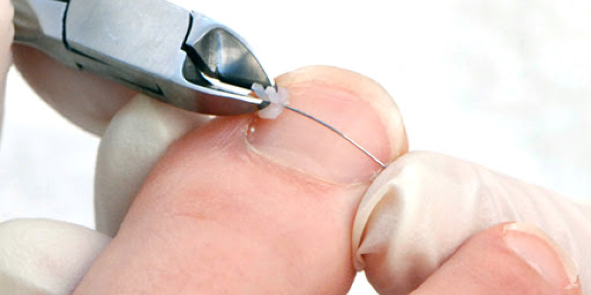 rieducazione ungueale medical group