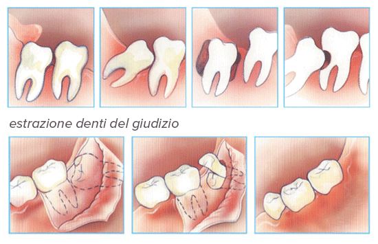 estrazione denti del giudizio