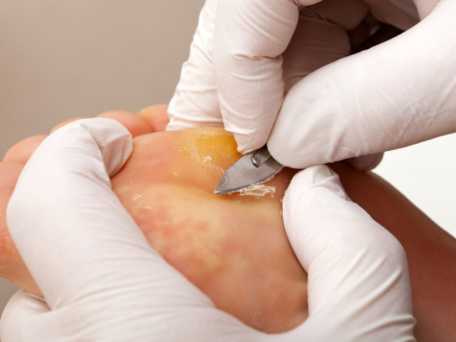 terapia metatarsalgia