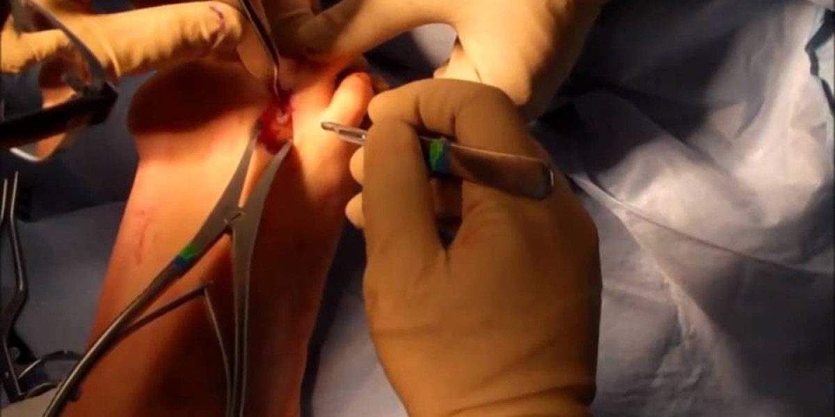 trattamento chirurgico neuroma di Morton medical group